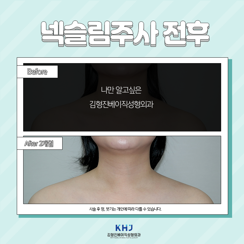 넥슬림주사전후 궁금하셨다면 보고 가세요! 관련 이미지 6