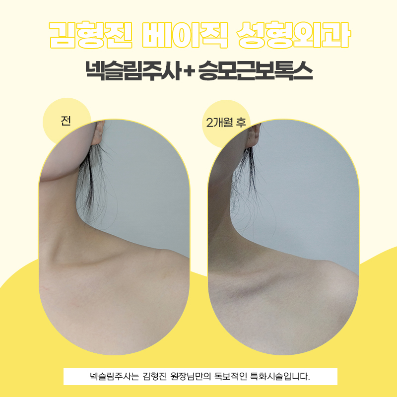 넥슬림주사로 목얇아지는방법 김형진베이직이 유일합니다 관련 이미지 6