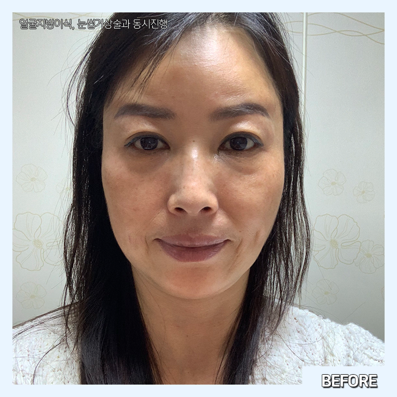 미니하안검회복과정 확인하고 가세요! 관련 이미지 2