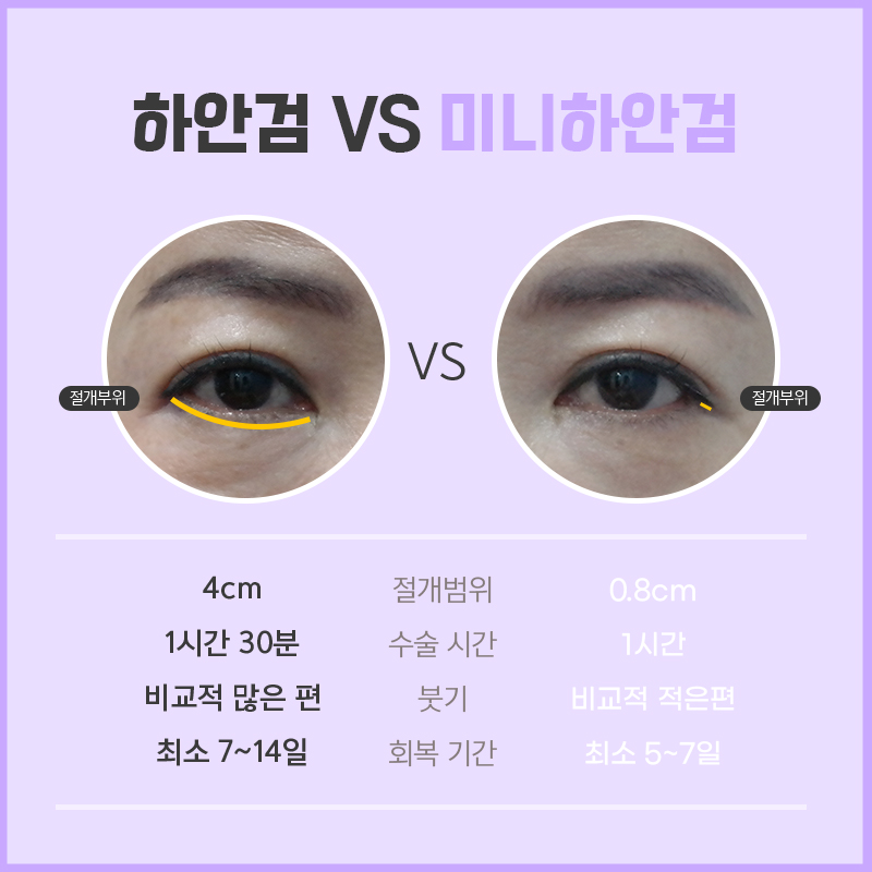 눈밑처짐수술 계속 고민 중이라면 관련 이미지 5