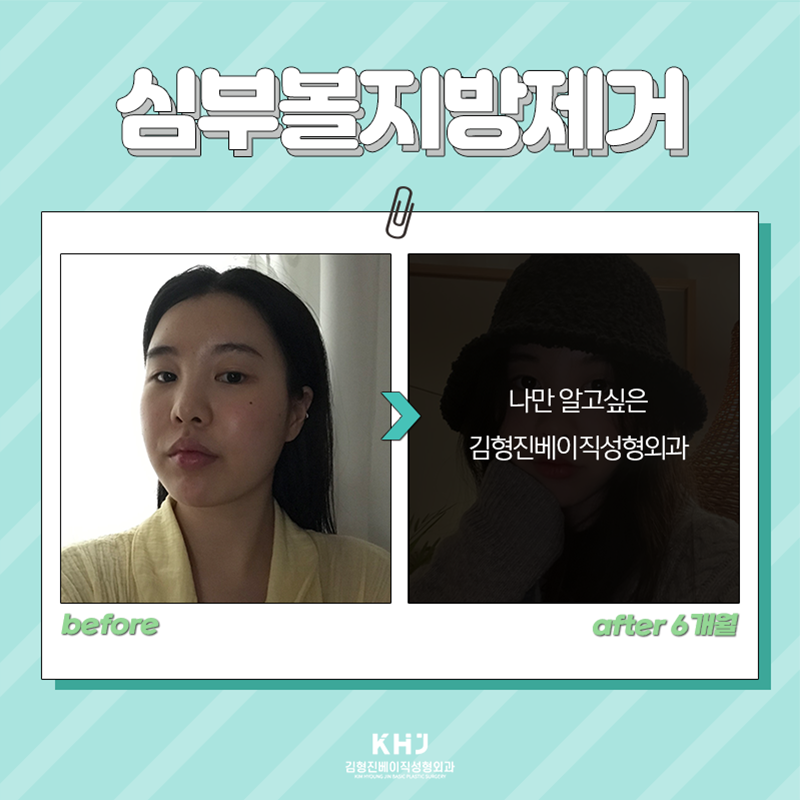 심부볼위치 정확하게 알려드릴게요! 관련 이미지 4