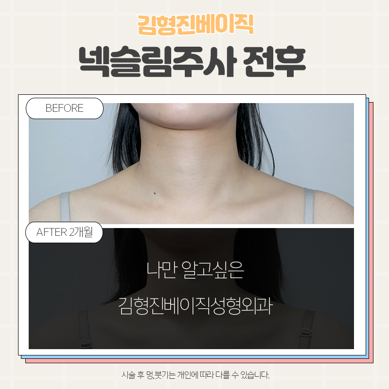 목보톡스전후 궁금하셨다면 여기로! 관련 이미지 2