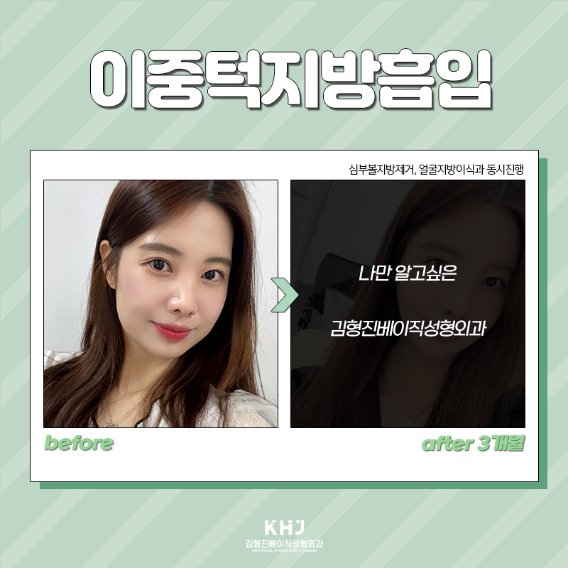 이중턱지방흡입전후 확인하고 가세요! 관련 이미지 2