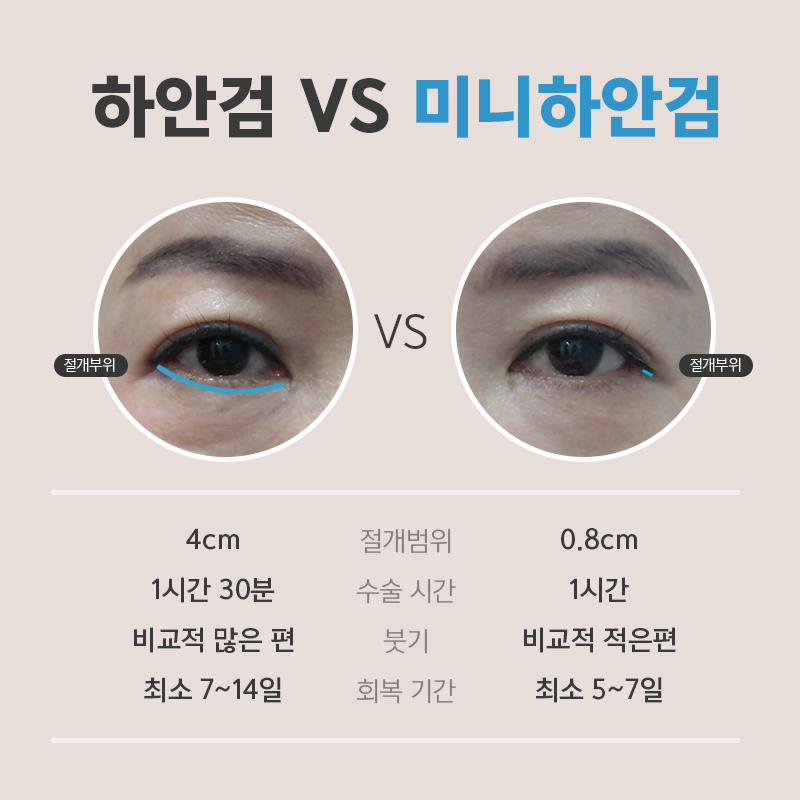 미니하안검 너무 괜찮죠? 관련 이미지 3