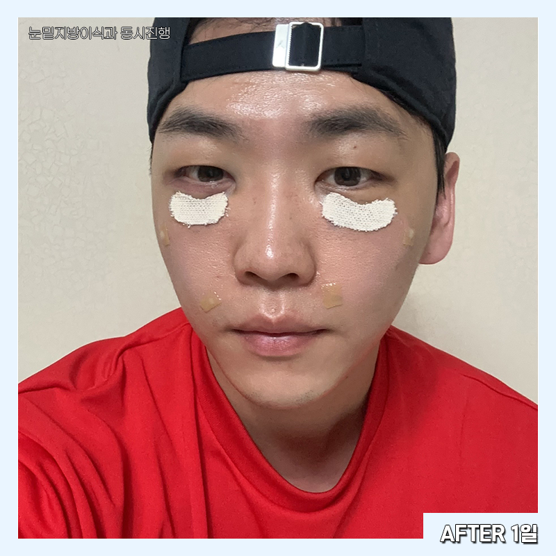 눈밑지방재배치변화과정 한눈에 확인하고 가세요! 관련 이미지 4