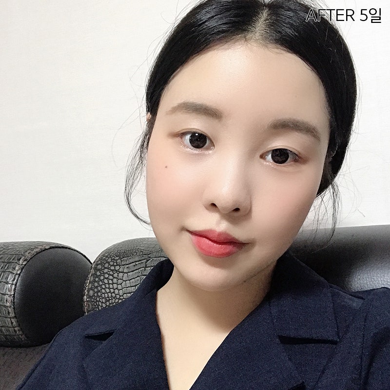 심부볼제거술, 확실한 볼살제거 방법 관련 이미지 4