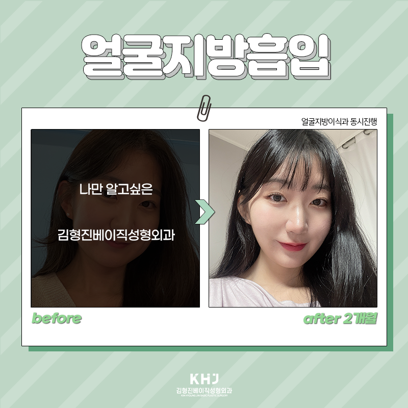 얼굴지방흡입전후 이렇게나 좋다구? 관련 이미지 6