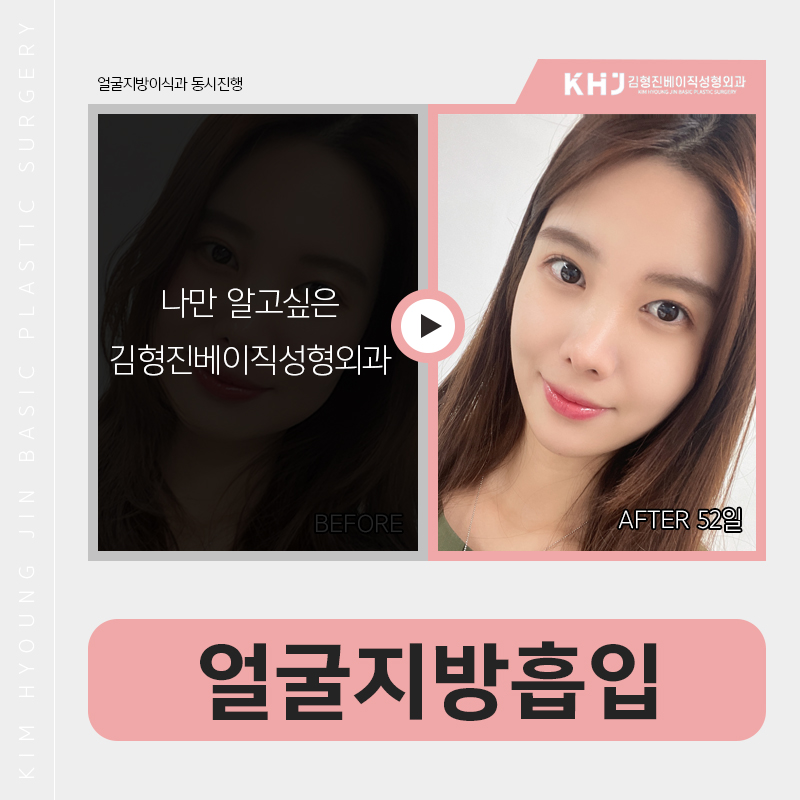 얼굴지방흡입처짐 걱정하시고계세요? 관련 이미지 4