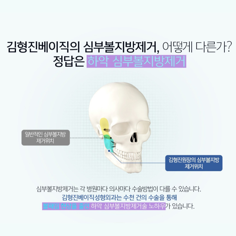 얼굴지흡후기 얼굴살 정리와 탄력을 한 번에! 관련 이미지 4