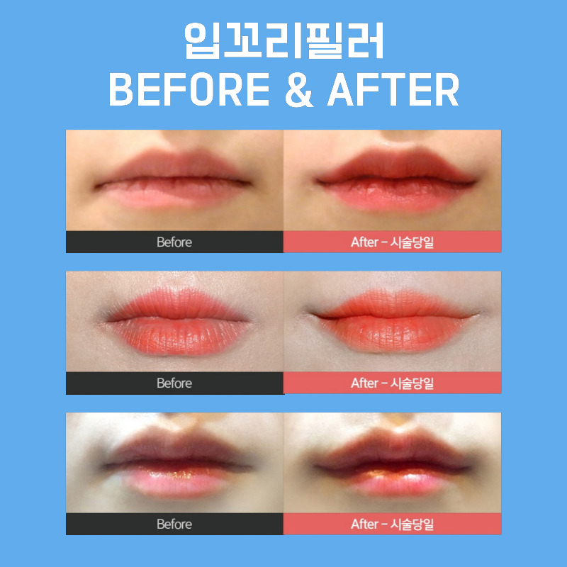 There’s Nothing Better for Correcting Asymmetrical Mouth Corners image 5