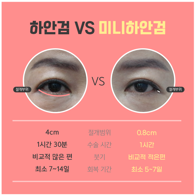 혹시 미니하안검비용 때문에 망설이고 계셨다면 관련 이미지 4