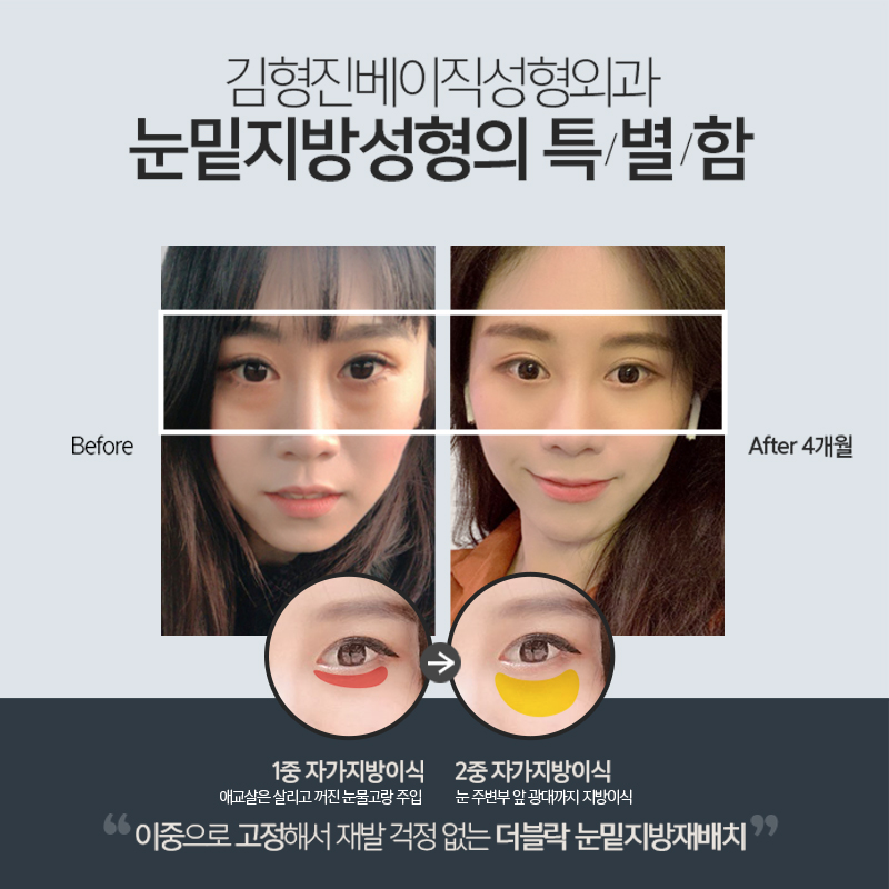 눈밑지방재배치유지력 오래가는 곳 찾으신다면? 관련 이미지 5