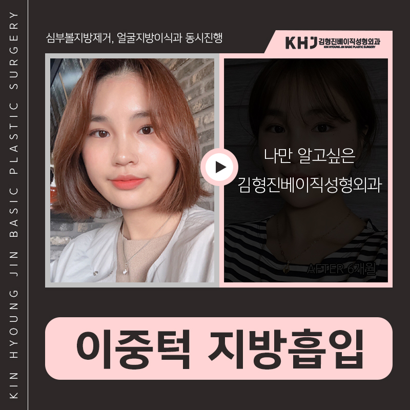 턱라인지방흡입 후기도 좋아 관련 이미지 2