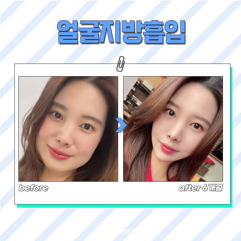 얼굴지방제거로 완벽한 얼굴형 완성하세요! 관련 이미지 6