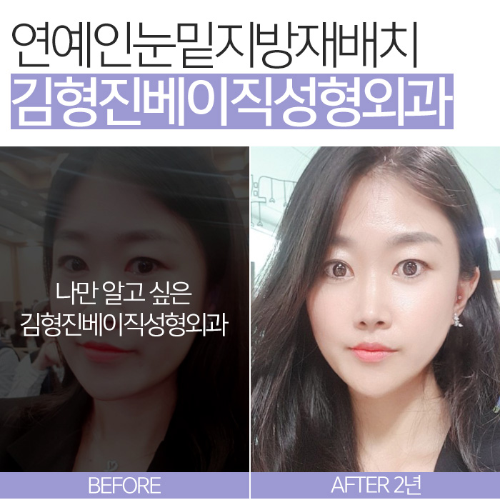 연예인눈밑지방재배치 이런 거구나 관련 이미지 7