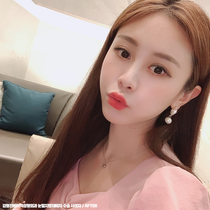 눈밑지방재배치후기 봐줄거죠? 관련 이미지 4