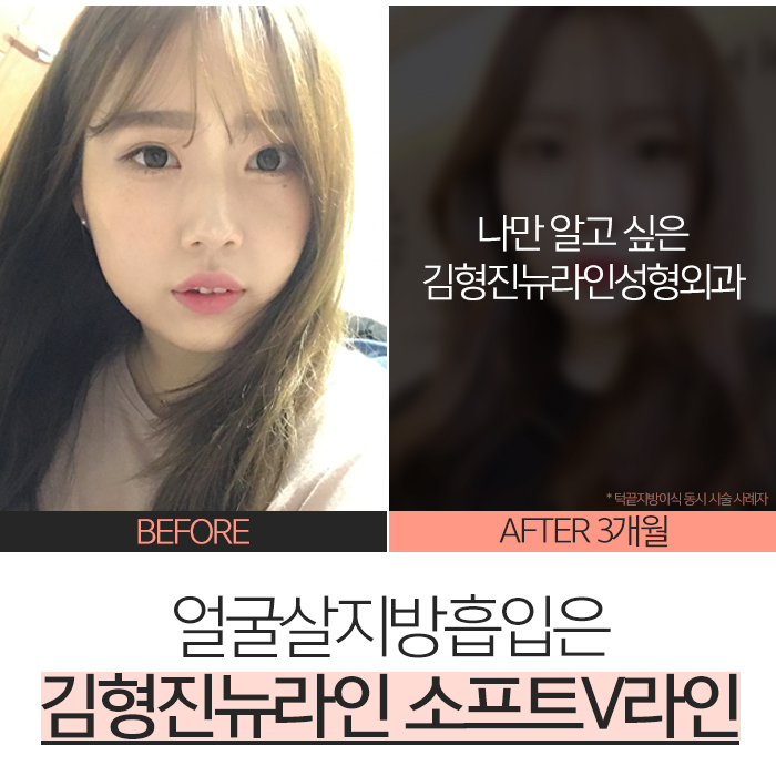 얼굴살지방흡입 하려면 이걸 해야지! 관련 이미지 2