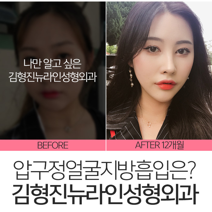 압구정얼굴지방흡입 잘한다고 했죠? 관련 이미지 2