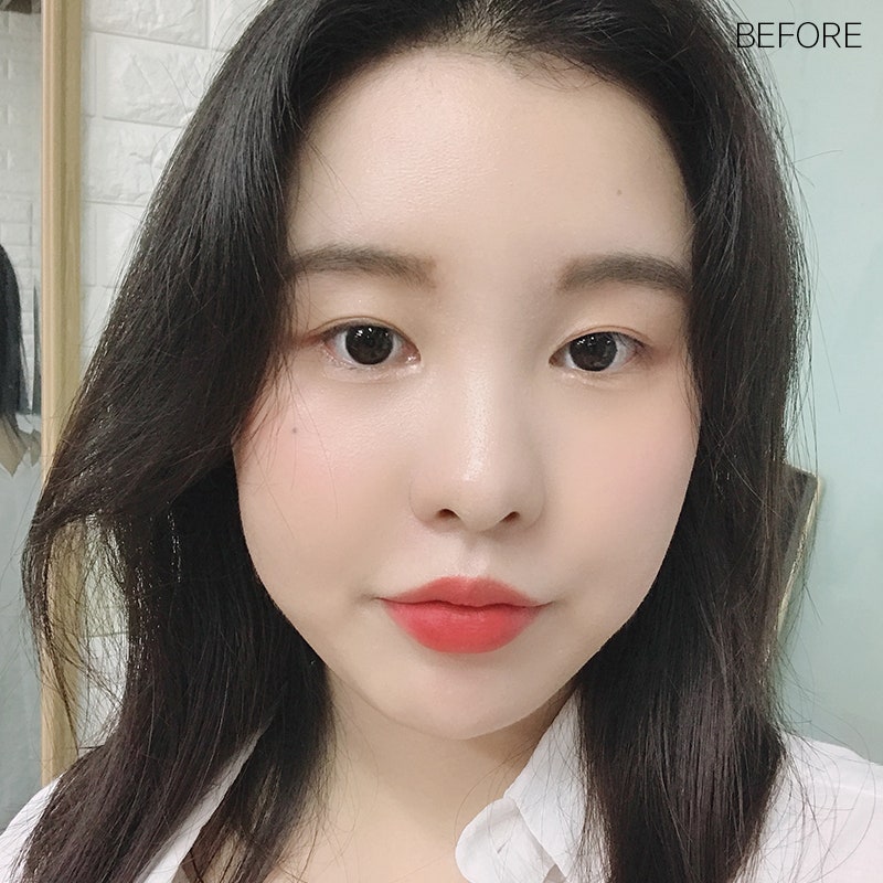 심부볼제거술, 확실한 볼살제거 방법 관련 이미지 2