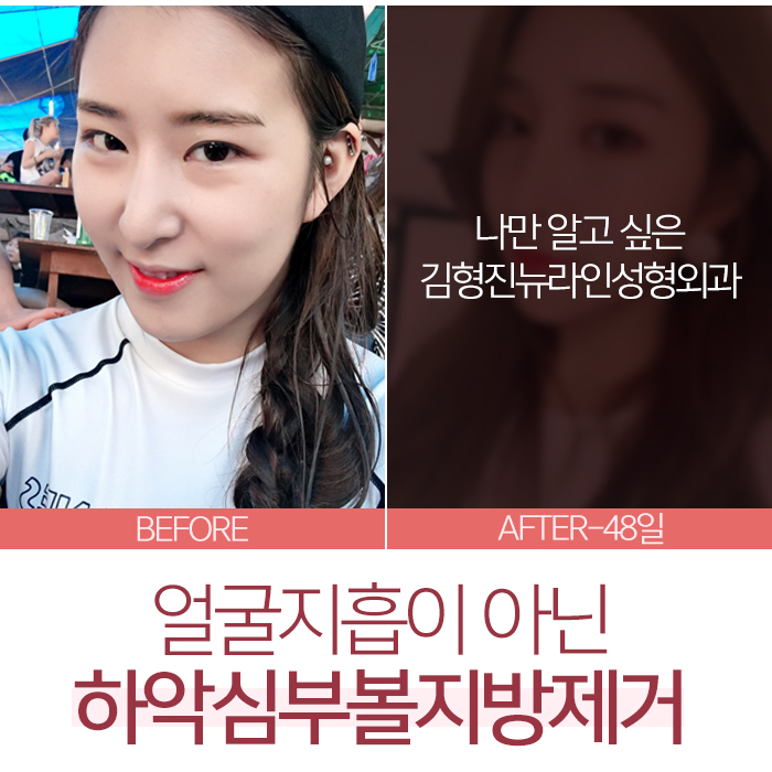 얼굴지흡 하기전에 이것부터 관련 이미지 2