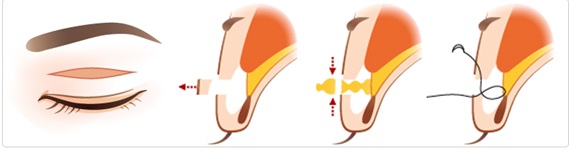 <정보> 쌍꺼풀수술 - 절개법 & 다매듭(멀티락) 매몰법 관련 이미지 2