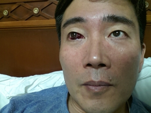 결막하출혈 관련 이미지 2