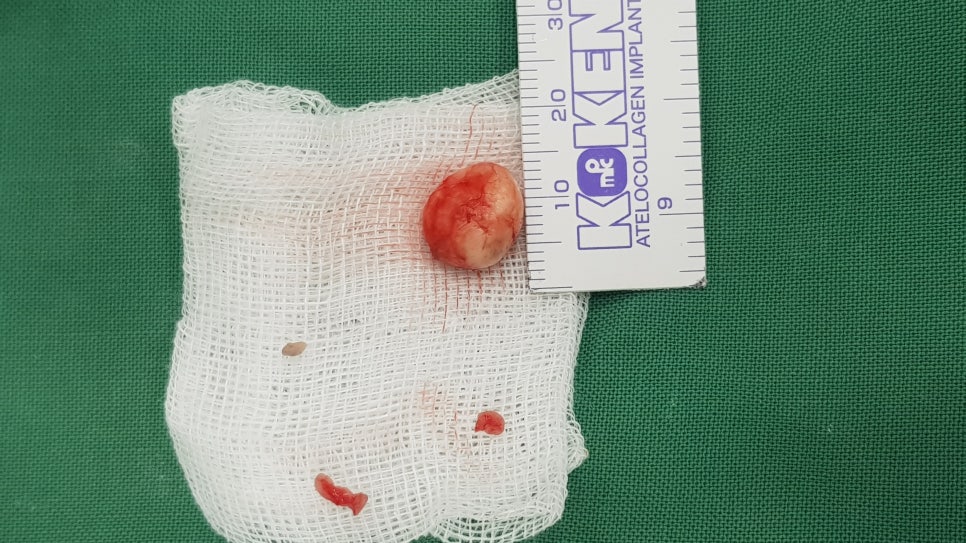 피지낭 혹은 표피낭 제거수술 관련 이미지 3