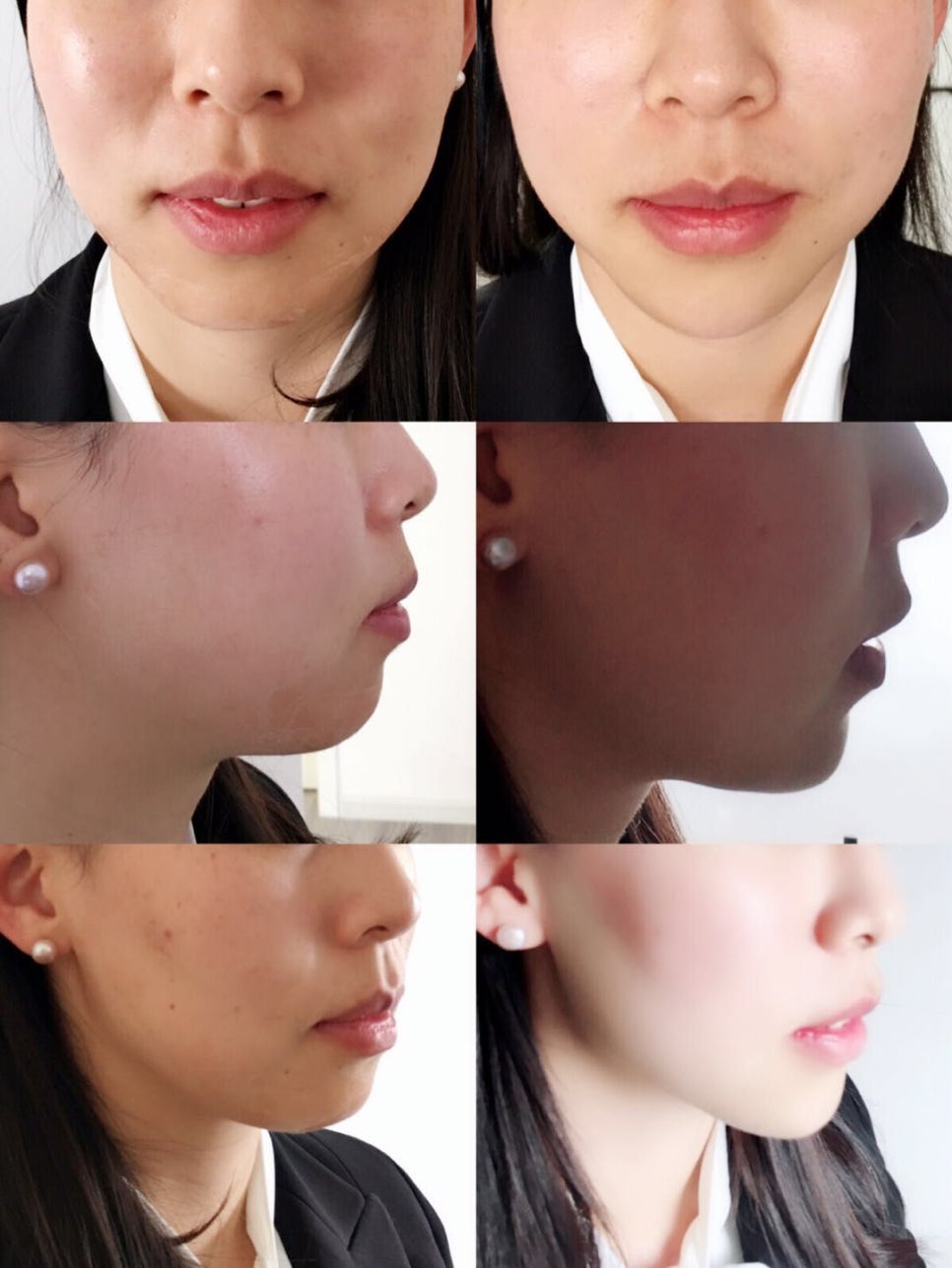 '필러 ' 그 한계는 어디인가? : 네이버 블로그 관련 이미지 4