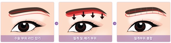 <정보> 상안검성형술 - PART 2. 상안검주름제거술 관련 이미지 2