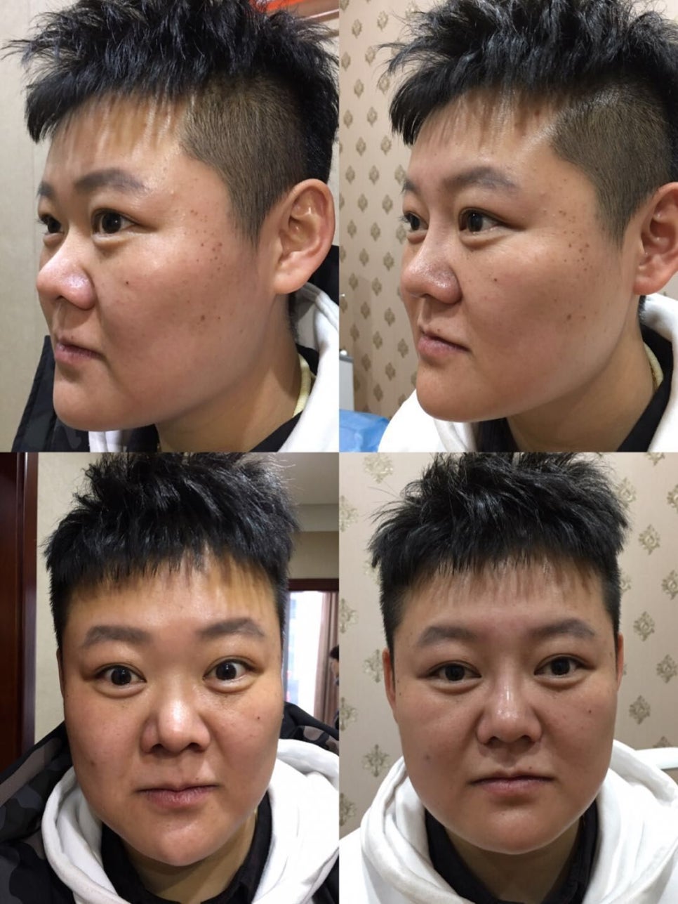 '필러 ' 그 한계는 어디인가? : 네이버 블로그 관련 이미지 2