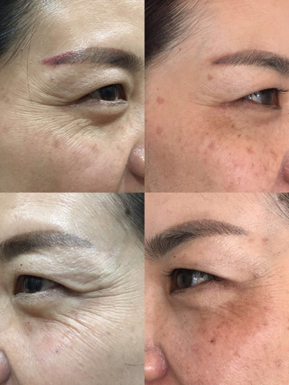 보톡스 이모저모 관련 이미지 2