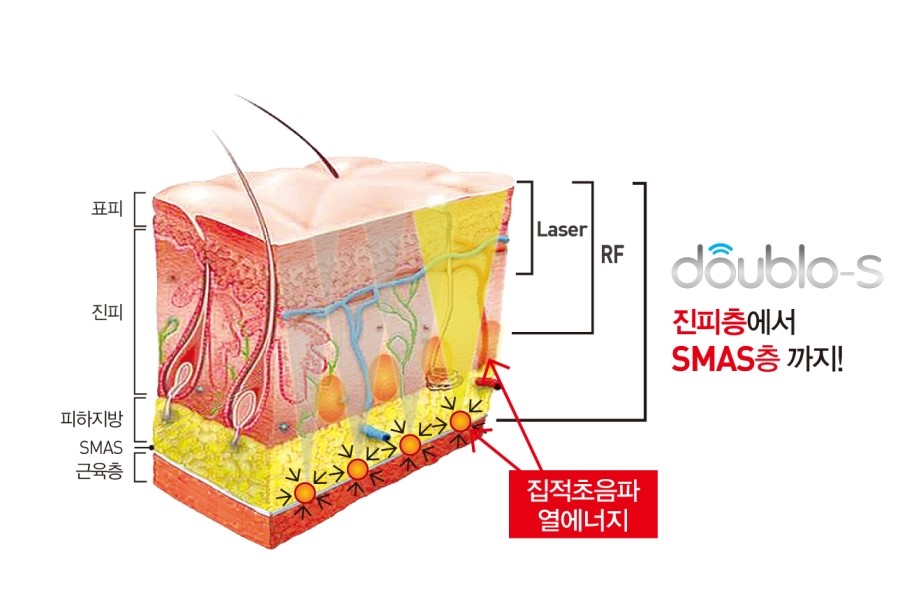 <에스테틱> 더블로 리프팅 - 수술없이 주름개선과 리프팅을 동시에 - 관련 이미지 3