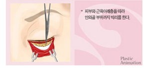 <정보> 하안검성형술 - 눈밑주름 및 다크써클 교정술 관련 이미지 5