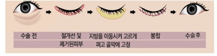 <정보> 하안검성형술 - 눈밑주름 및 다크써클 교정술 관련 이미지 4
