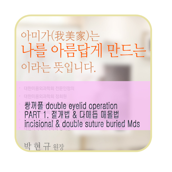 <정보> 쌍꺼풀수술 - 절개법 & 다매듭(멀티락) 매몰법 관련 이미지 1