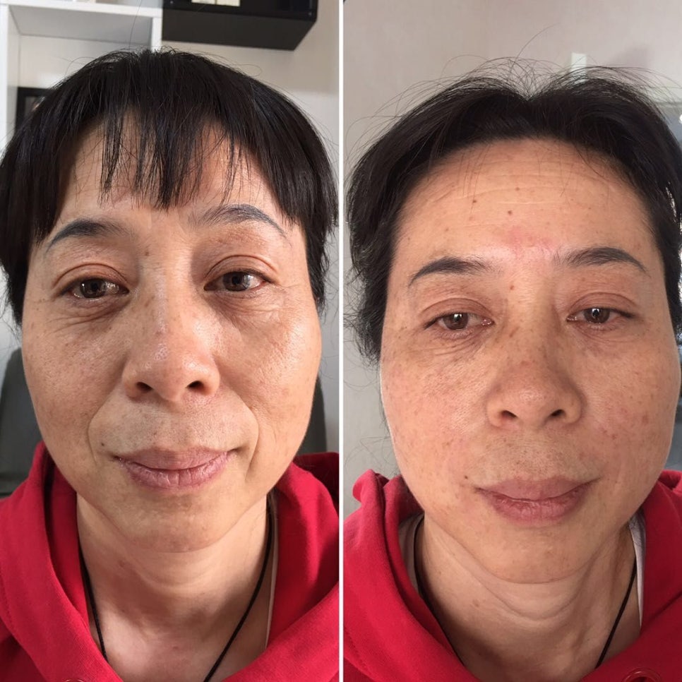 '필러 ' 그 한계는 어디인가? : 네이버 블로그 관련 이미지 1