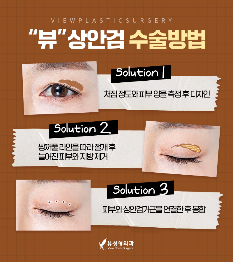 처지고 주름진 피부를 개선하는 다양한 동안성형 방법 관련 이미지 7