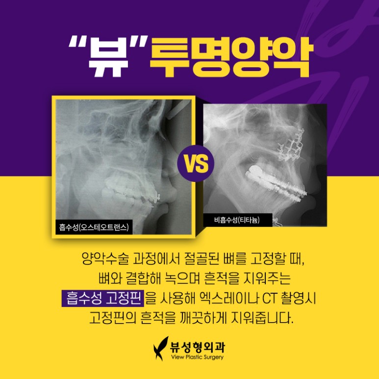 예뻐지는 수술? 양악수술의 올바른 정보 관련 이미지 4