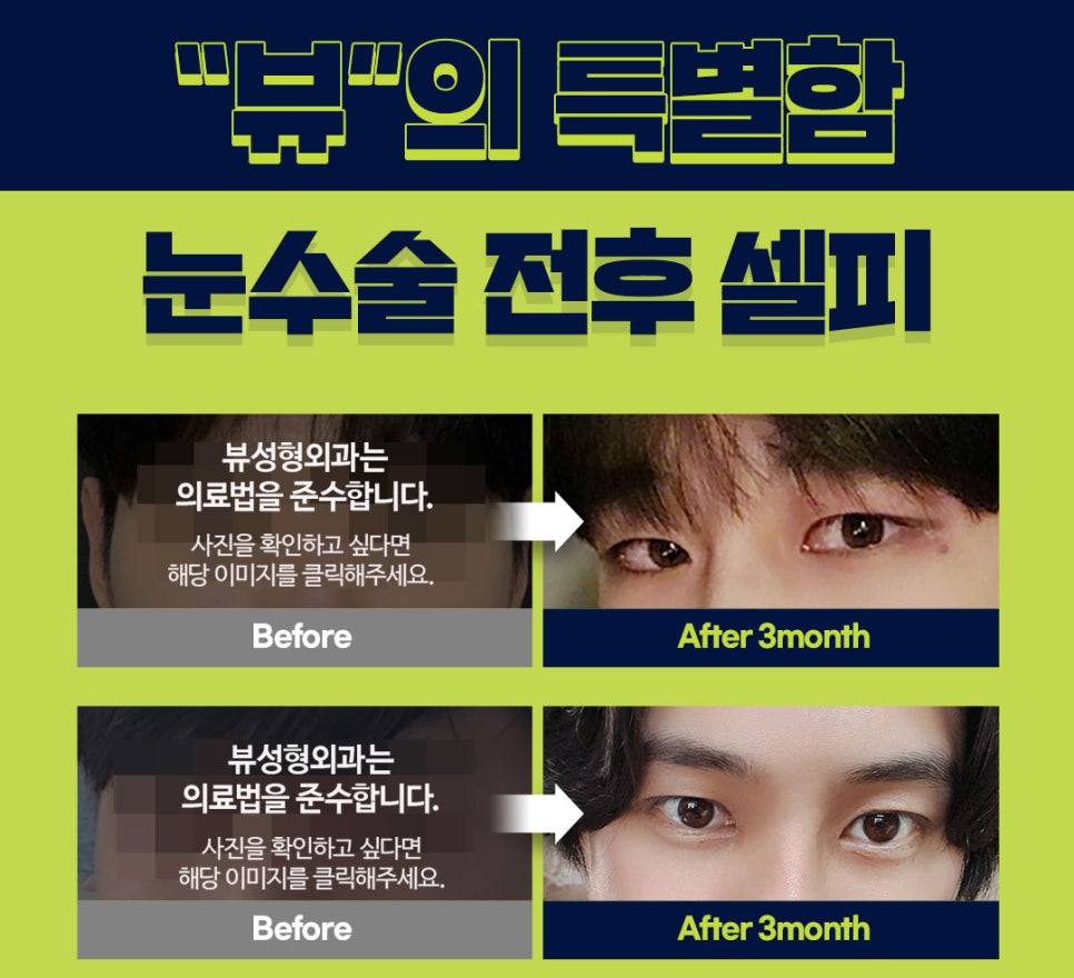 남자눈성형잘하는곳 뷰성형외과 남자콤비매몰이란? 관련 이미지 5