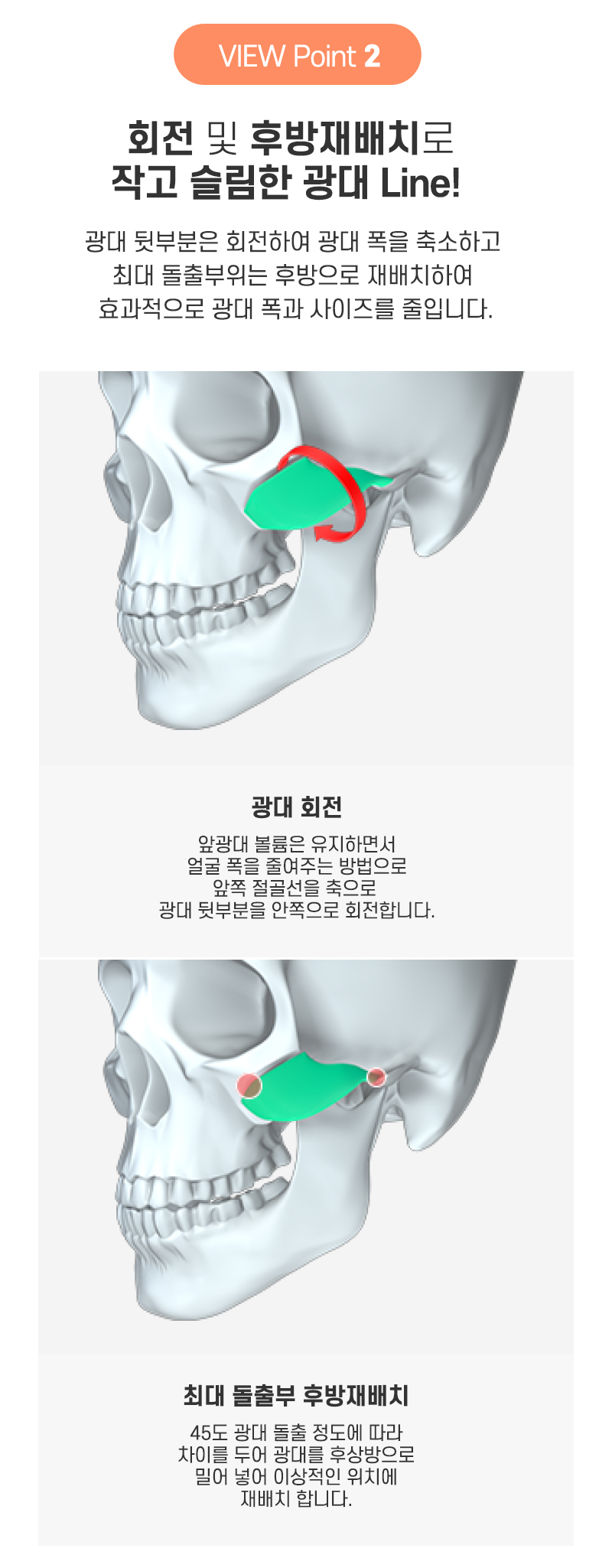 광대축소, 부작용은 줄이고 효과는 높이고 싶다면 관련 이미지 8