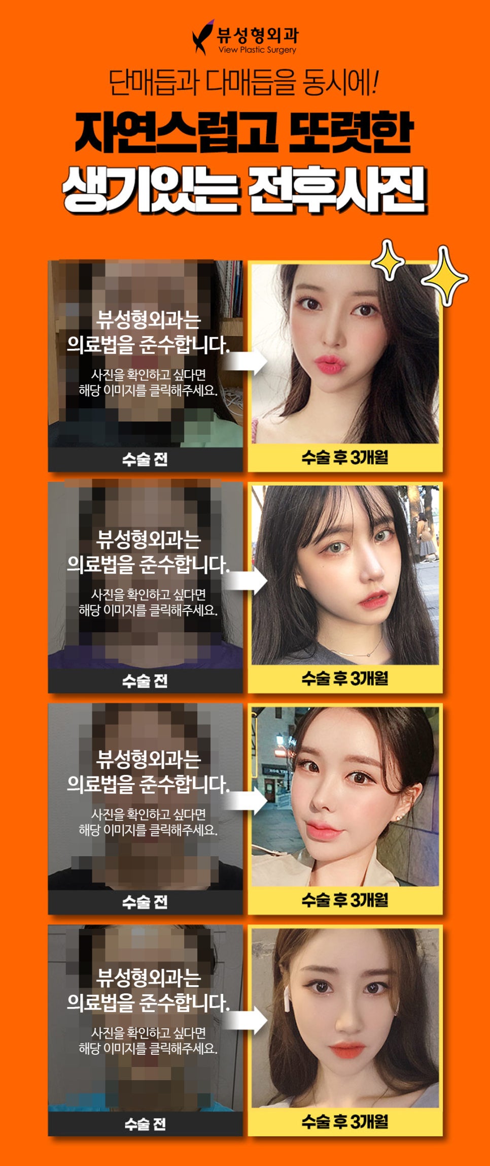 쌍꺼풀 절개법과 매몰법, 어떤 방법이 더 좋을까? 관련 이미지 6