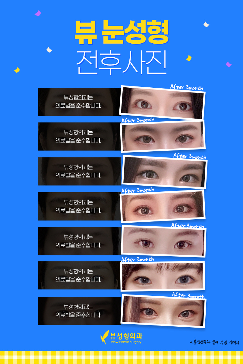 눈재수술유명한곳, 뷰성형외과 관련 이미지 6