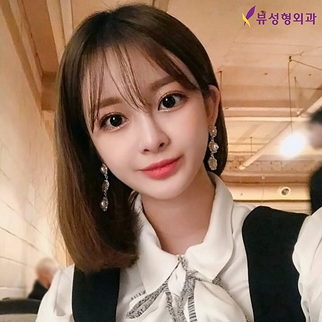 눈매교정수술전후 차이를 더 또렷하게 관련 이미지 2