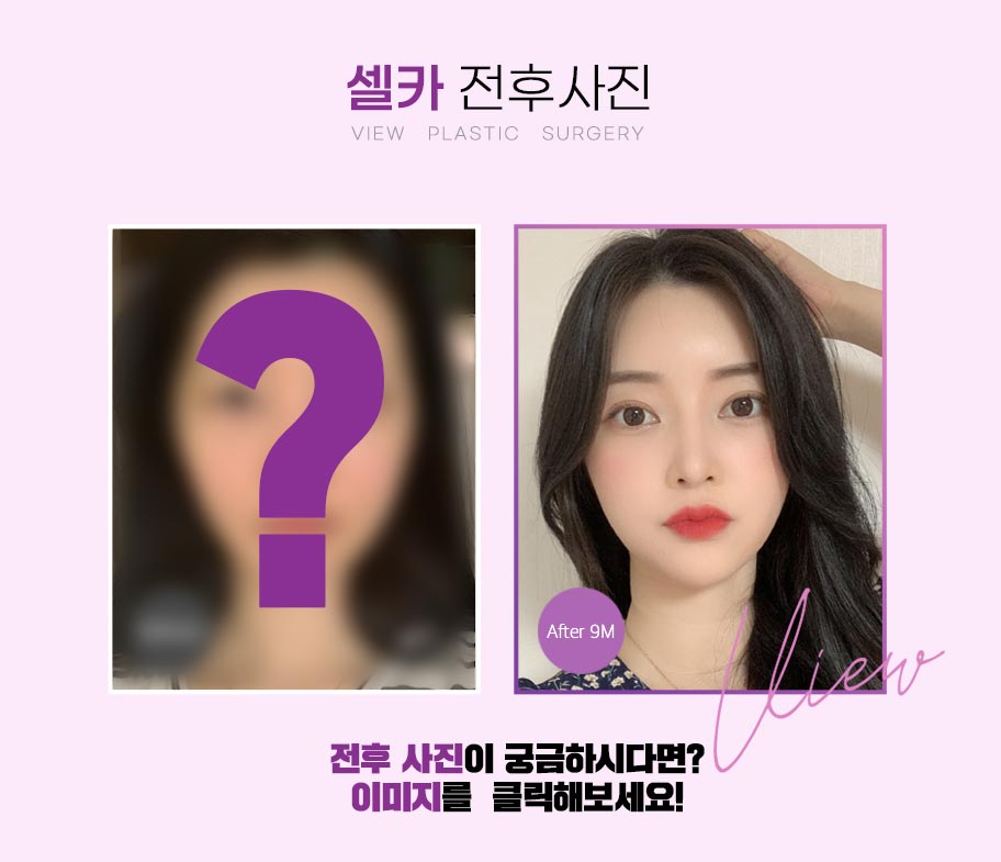 조화로운 비절개눈매교정 하고 싶다면 관련 이미지 18