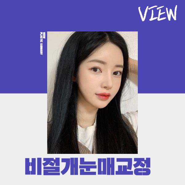 조화로운 비절개눈매교정 하고 싶다면 관련 이미지 7