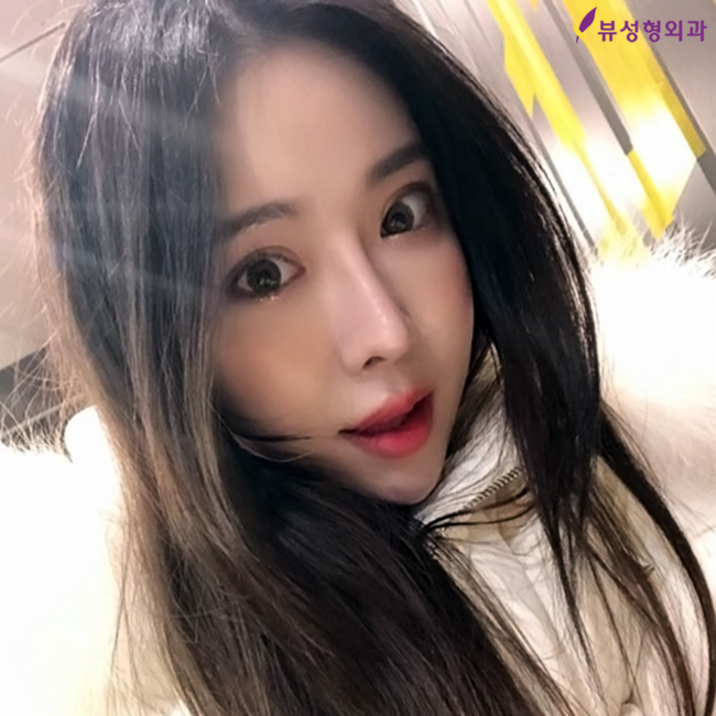 여자매부리코성형으로 여성미 한껏 뽐내봐요~! 관련 이미지 1