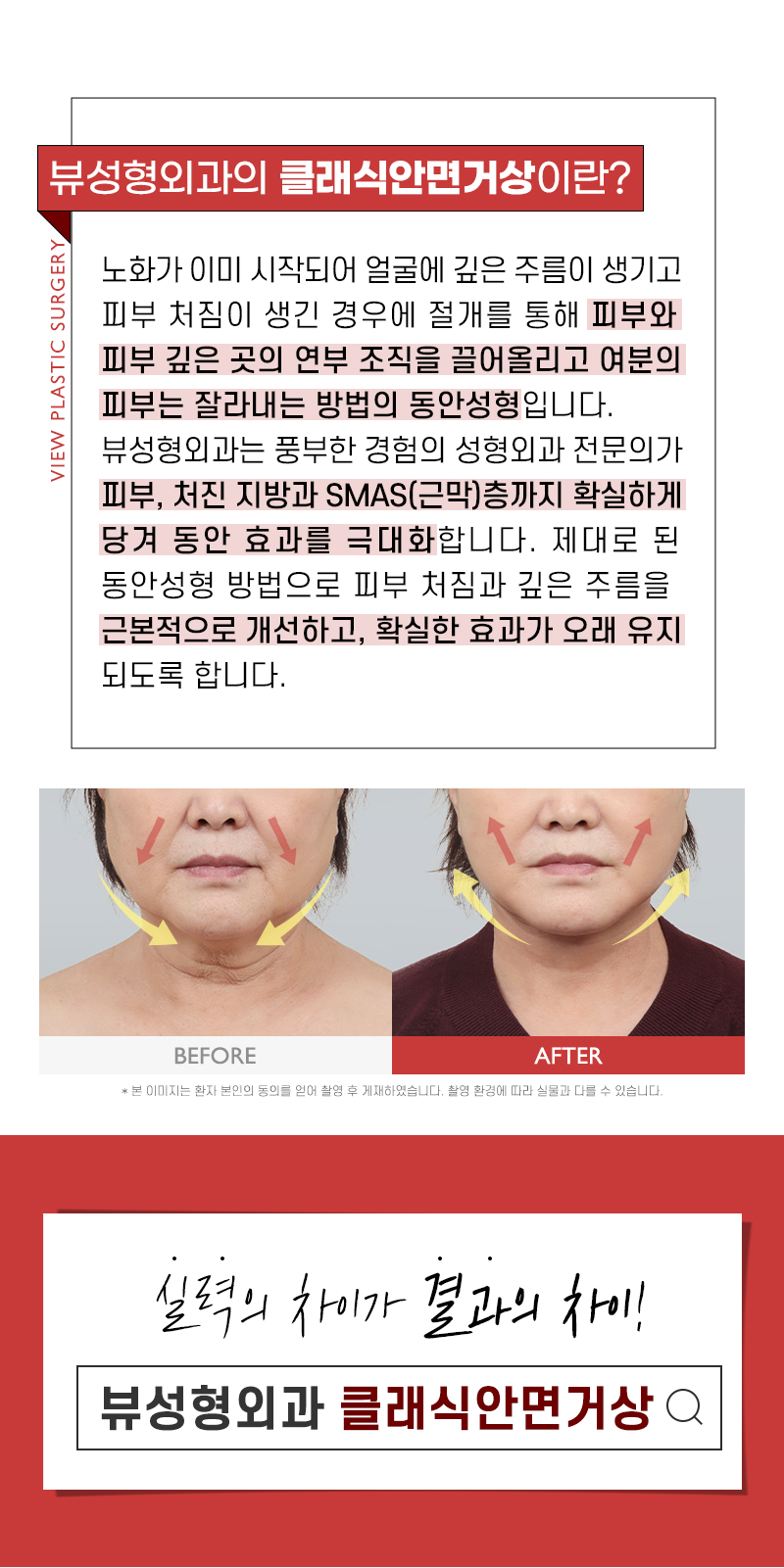 자꾸만 처지고 늘어지는 피부, 안면거상을 통한 안티에이징 관련 이미지 4