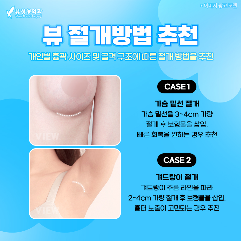 가슴수술, 부작용은 낮추고 안정성과 자연스러움을 높일려면? 관련 이미지 11