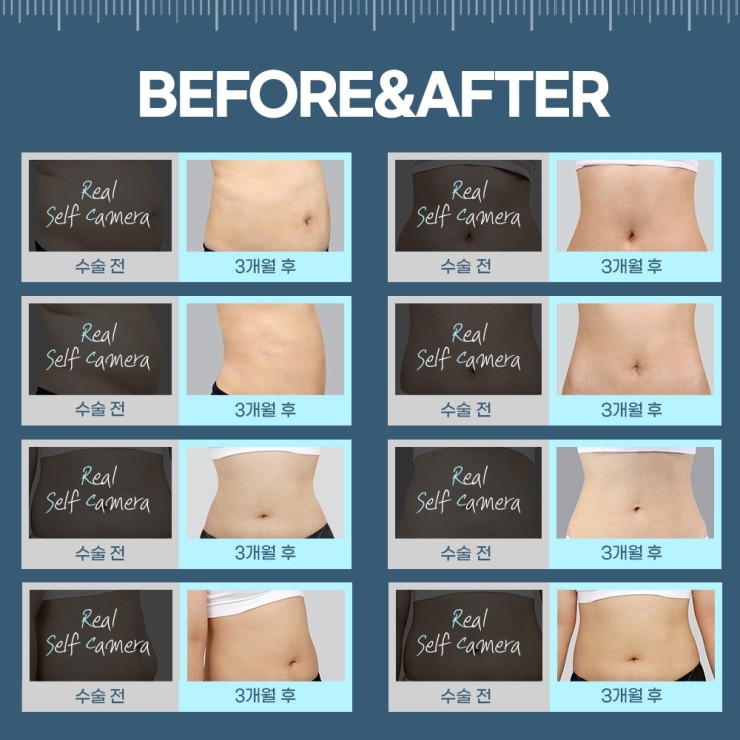 지방흡입, 체중감량술이 아닌 체형교정술 관련 이미지 8