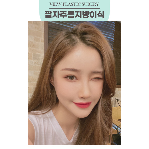 팔자주름지방이식 으로 젊어지자! 관련 이미지 13